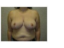 Breast Reduction After Photo by Frank Ferraro, MD; Paramus, NJ - Case 9530