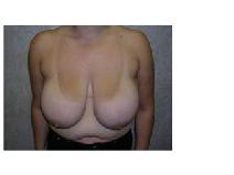 Breast Reduction Before Photo by Frank Ferraro, MD; Paramus, NJ - Case 9530