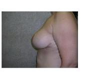 Breast Reduction After Photo by Frank Ferraro, MD; Paramus, NJ - Case 9530