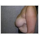 Breast Reduction Before Photo by Frank Ferraro, MD; Paramus, NJ - Case 9530