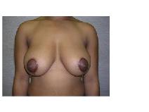Breast Lift After Photo by Frank Ferraro, MD; Paramus, NJ - Case 9531