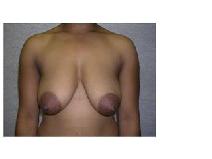 Breast Lift Before Photo by Frank Ferraro, MD; Paramus, NJ - Case 9531