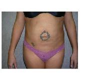 Liposuction After Photo by Frank Ferraro, MD; Paramus, NJ - Case 9533