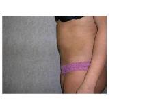 Liposuction After Photo by Frank Ferraro, MD; Paramus, NJ - Case 9533