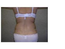 Liposuction After Photo by Frank Ferraro, MD; Paramus, NJ - Case 9534