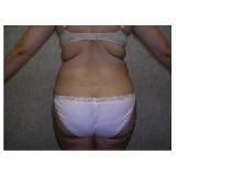 Liposuction Before Photo by Frank Ferraro, MD; Paramus, NJ - Case 9534