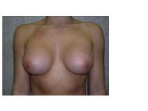 Breast Augmentation After Photo by Frank Ferraro, MD; Paramus, NJ - Case 9535