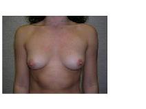 Breast Augmentation Before Photo by Frank Ferraro, MD; Paramus, NJ - Case 9535