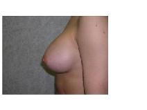 Breast Augmentation After Photo by Frank Ferraro, MD; Paramus, NJ - Case 9535
