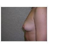 Breast Augmentation Before Photo by Frank Ferraro, MD; Paramus, NJ - Case 9535