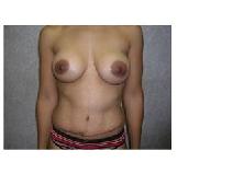 Tummy Tuck After Photo by Frank Ferraro, MD; Paramus, NJ - Case 9536