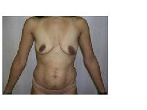 Tummy Tuck Before Photo by Frank Ferraro, MD; Paramus, NJ - Case 9536