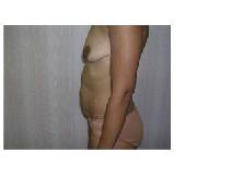 Tummy Tuck Before Photo by Frank Ferraro, MD; Paramus, NJ - Case 9536