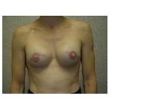 Breast Reconstruction After Photo by Frank Ferraro, MD; Paramus, NJ - Case 9537