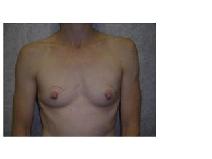 Breast Reconstruction Before Photo by Frank Ferraro, MD; Paramus, NJ - Case 9537