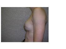 Breast Reconstruction After Photo by Frank Ferraro, MD; Paramus, NJ - Case 9537