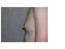 Breast Reconstruction Before Photo by Frank Ferraro, MD; Paramus, NJ - Case 9537
