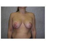 Breast Lift After Photo by Frank Ferraro, MD; Paramus, NJ - Case 9562