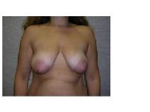 Breast Lift Before Photo by Frank Ferraro, MD; Paramus, NJ - Case 9562