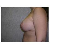Breast Lift After Photo by Frank Ferraro, MD; Paramus, NJ - Case 9562