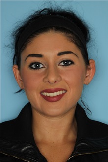 Rhinoplasty After Photo by Homayoun Sasson, MD, FACS; Great Neck, NY - Case 31733