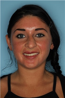 Rhinoplasty Before Photo by Homayoun Sasson, MD, FACS; Great Neck, NY - Case 31733