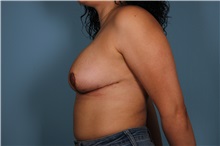 Breast Lift After Photo by Homayoun Sasson, MD, FACS; Great Neck, NY - Case 31737