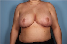 Breast Reduction After Photo by Homayoun Sasson, MD, FACS; Great Neck, NY - Case 31744