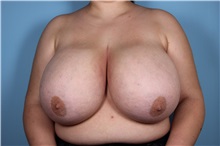 Breast Reduction Before Photo by Homayoun Sasson, MD, FACS; Great Neck, NY - Case 31744