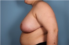 Breast Reduction After Photo by Homayoun Sasson, MD, FACS; Great Neck, NY - Case 31745