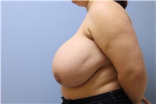 Breast Reduction Before Photo by Homayoun Sasson, MD, FACS; Great Neck, NY - Case 31745