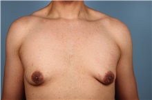 Male Breast Reduction Before Photo by Homayoun Sasson, MD, FACS; Great Neck, NY - Case 31746