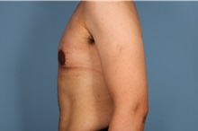 Male Breast Reduction After Photo by Homayoun Sasson, MD, FACS; Great Neck, NY - Case 31747