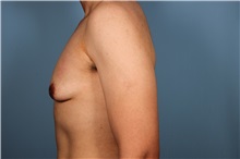 Male Breast Reduction Before Photo by Homayoun Sasson, MD, FACS; Great Neck, NY - Case 31747