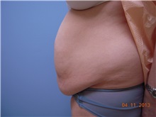Tummy Tuck Before Photo by Homayoun Sasson, MD, FACS; Great Neck, NY - Case 31748