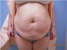 Tummy Tuck Before Photo by Homayoun Sasson, MD, FACS; Great Neck, NY - Case 31749