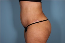 Tummy Tuck After Photo by Homayoun Sasson, MD, FACS; Great Neck, NY - Case 31750