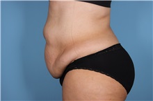 Tummy Tuck Before Photo by Homayoun Sasson, MD, FACS; Great Neck, NY - Case 31750