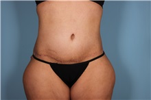 Tummy Tuck After Photo by Homayoun Sasson, MD, FACS; Great Neck, NY - Case 31751