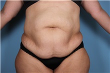 Tummy Tuck Before Photo by Homayoun Sasson, MD, FACS; Great Neck, NY - Case 31751