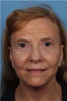 Facelift After Photo by Homayoun Sasson, MD, FACS; Great Neck, NY - Case 31754