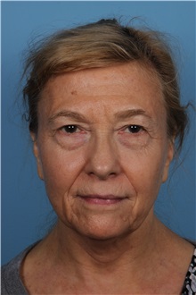 Facelift Before Photo by Homayoun Sasson, MD, FACS; Great Neck, NY - Case 31754