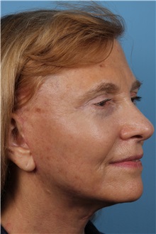 Facelift After Photo by Homayoun Sasson, MD, FACS; Great Neck, NY - Case 31755