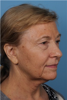 Facelift Before Photo by Homayoun Sasson, MD, FACS; Great Neck, NY - Case 31755