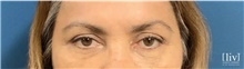 Eyelid Surgery After Photo by Andrew Ress, MD; Boca Raton, FL - Case 48662