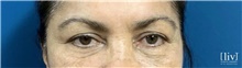 Eyelid Surgery Before Photo by Andrew Ress, MD; Boca Raton, FL - Case 48662