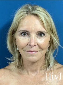 Neck Lift After Photo by Andrew Ress, MD; Boca Raton, FL - Case 48663