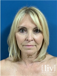 Neck Lift Before Photo by Andrew Ress, MD; Boca Raton, FL - Case 48663