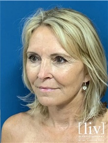 Neck Lift After Photo by Andrew Ress, MD; Boca Raton, FL - Case 48663