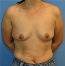 Breast Augmentation Before Photo by Suresh Koneru, MD; ,  - Case 50262